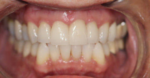 teeth after orthodontics