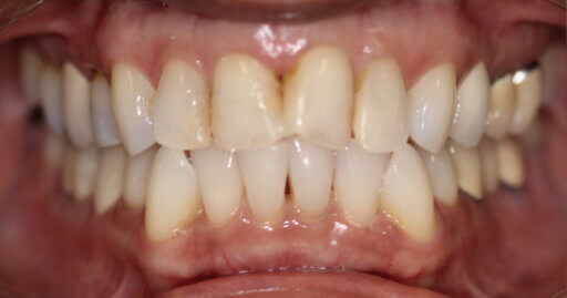 teeth before orthodontics