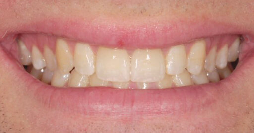 teeth after orthodontics