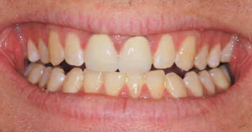 teeth before dental services at bristol park dental