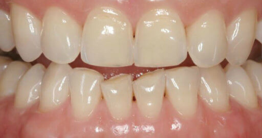 teeth before dental services