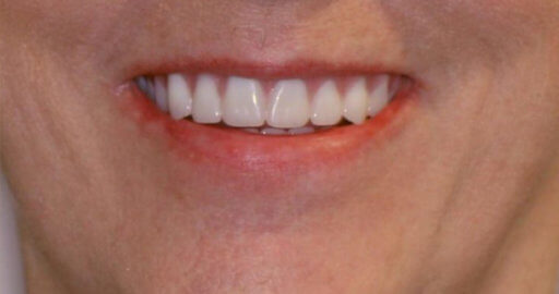 teeth after veneers