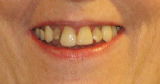 teeth before veneers