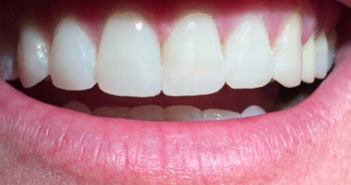 teeth after dental bonding