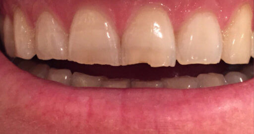 teeth before dental bonding