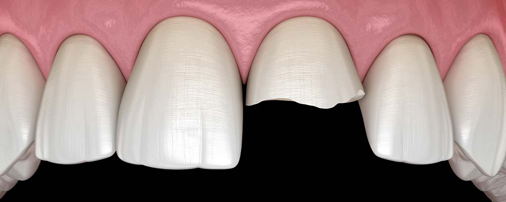 image of cracked teeth