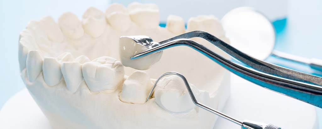 a dentist puts on dental crowns on a mold