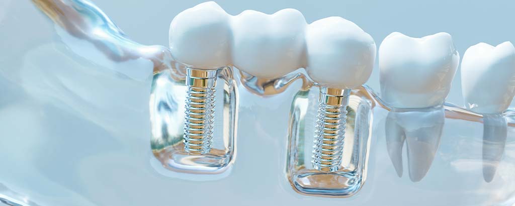 dental implants bristol