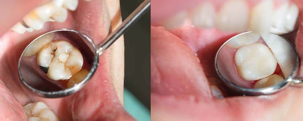 before and after images of tooth colored fillings