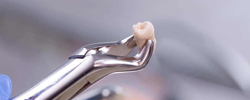 a dentist performs tooth extractions and holds up a tooth