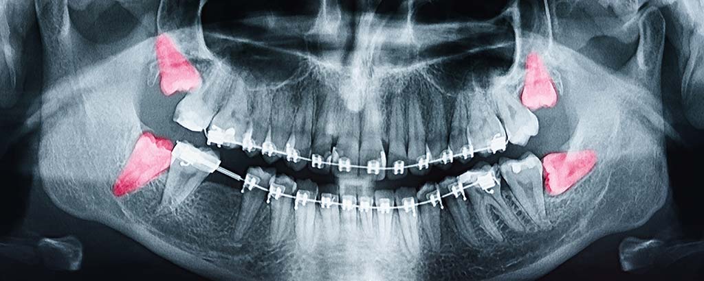 an x ray of a person who needs wisdom teeth removal