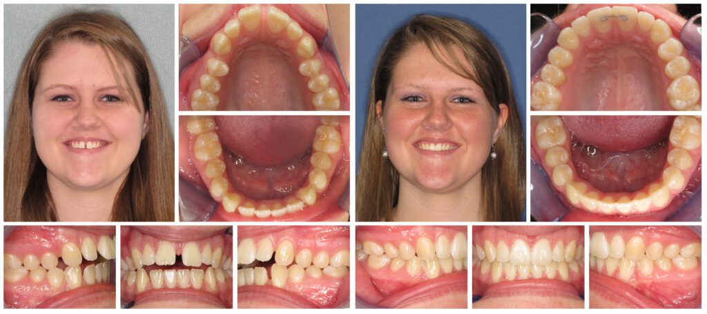 Invisalign dentist in Vermont