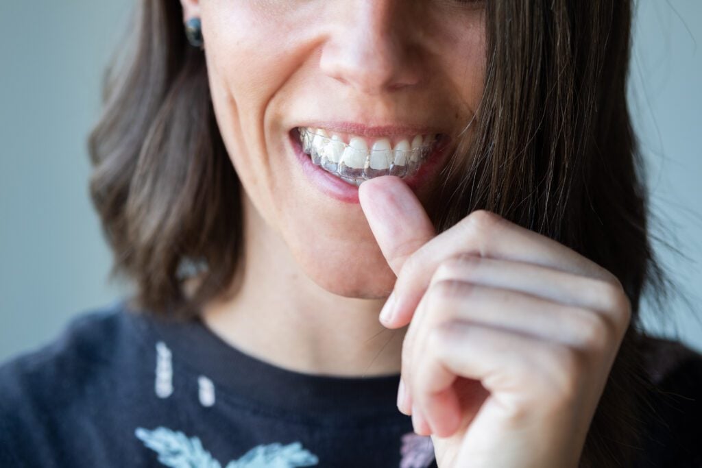 clear aligners in Bristol, Vermont